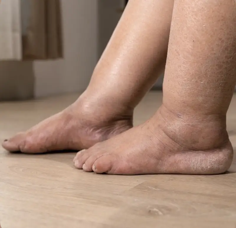 Linfedema